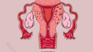 子宫肌瘤：五个女人就有一个中招，切还是留？不妨看看