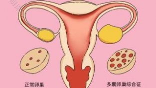 得了多囊卵巢综合征，如果有效地做到长期管理？建议参考下