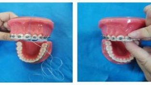 牙齿矫正期间如何控制牙菌斑？教你洁齿方法