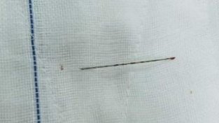 女子腰痛做针灸，不料5厘米银针“游”进腰间
